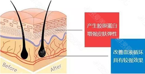 优雅斯线植入功效示意图 优雅斯线植入功效示意图