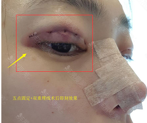 纯真医院五点固定法术后即刻效果图 纯真医院五点固定法术后即刻效果图