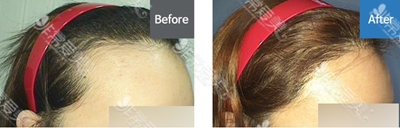 韩国丽兹RITZ皮肤科发际线移植对比图