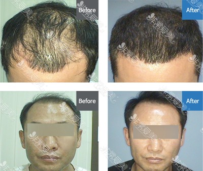 韩国丽兹RITZ皮肤科毛发移植案例
