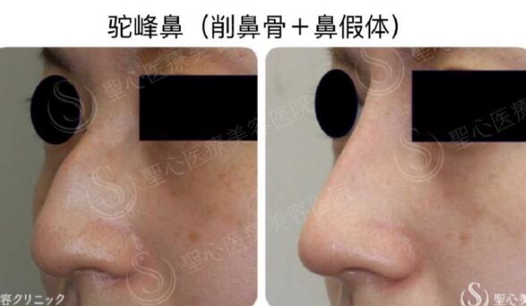 日本圣心医疗美容医院鼻部整形案例图
