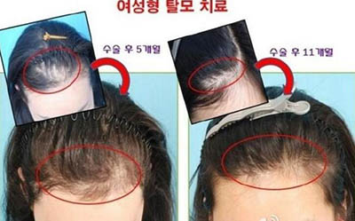 韩国毛爱林毛发移植医院毛发移植前后对比照片