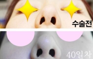 韩国Dream Face整形外科鼻修复案例