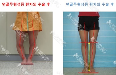 韩国rapha增高四肢医院矫正腿型案例图