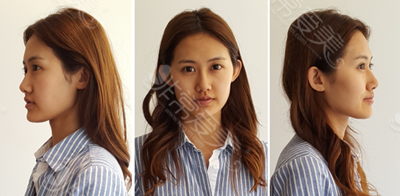 韩国在敦整形外科双眼皮真人案例术前图 韩国在敦整形外科双眼皮真人案例术前图