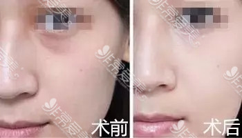 江南kbeauty整形外科陈泳完院长面部提升效果好吗 江南kbeauty整形外科陈泳完院长面部提升效果好吗