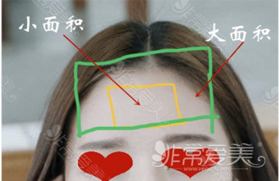 boneps医院额头填充位置 boneps医院额头填充位置
