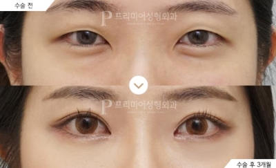 韩国普瑞美整形外科眼部整形案例图
