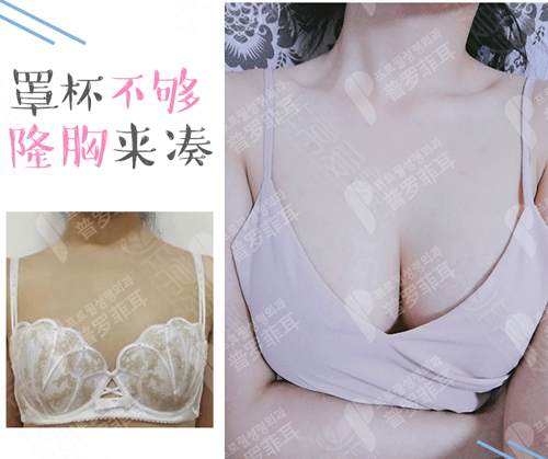 普罗菲耳profile医院隆胸前后对比图 普罗菲耳profile医院隆胸前后对比图