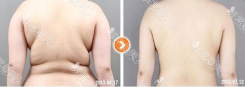 韩国365MC背部吸脂案例