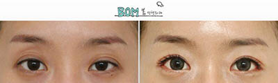 韩国春天UVOM整形外科眼部整形案例图
