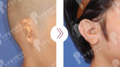 韩国Profile普罗菲耳耳再造手术对比效果