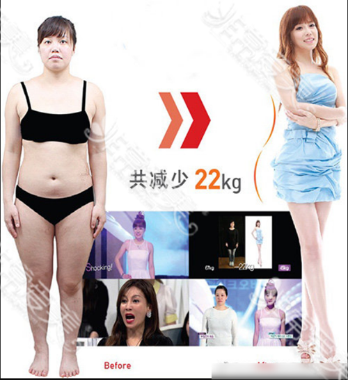 365mc医院全身抽脂案例 365mc医院全身抽脂案例
