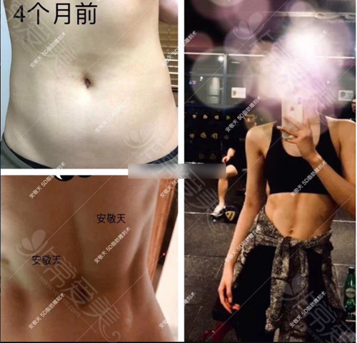 纯真医院腰腹吸脂案例 纯真医院腰腹吸脂案例