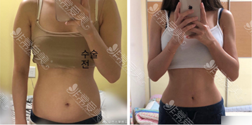 babiline医院腰腹吸脂案例 babiline医院腰腹吸脂案例