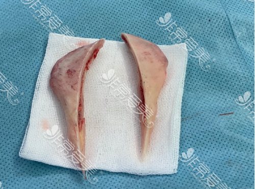 磨骨手术取出的多余骨骼 磨骨手术取出的多余骨骼
