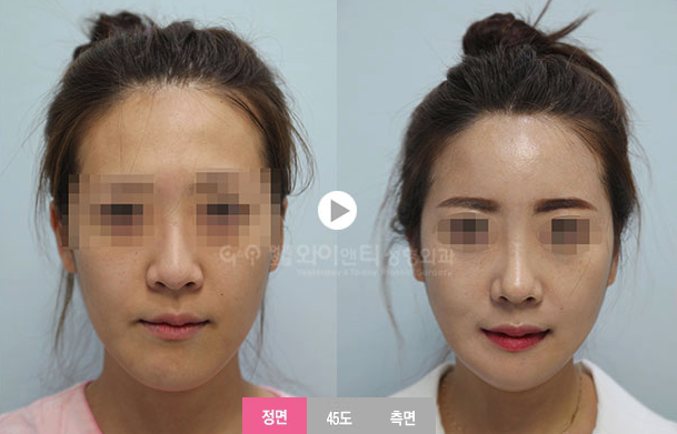 韩国YT整形外科面部轮廓对比案例