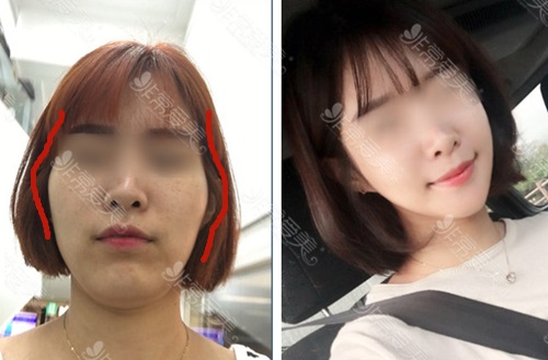 顴骨取釘子痛苦嗎 顴骨取釘子痛苦嗎
