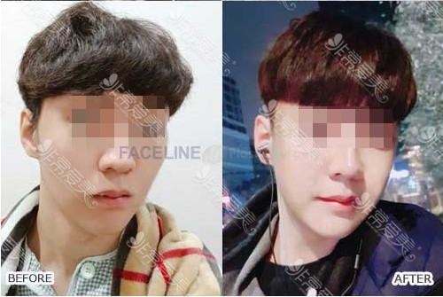 鈦釘能做核磁共振嗎 鈦釘能做核磁共振嗎