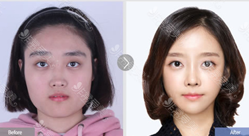顴骨取鈦釘是微創嗎 顴骨取鈦釘是微創嗎