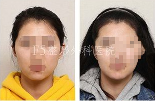 韩国F5整形外科颧骨缩小术案例