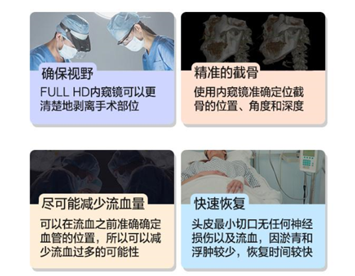 韩国F5整形外科颧骨缩小术优势有哪些