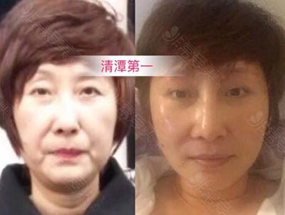 韩国清潭FIRST提升案例图 韩国清潭FIRST提升案例图