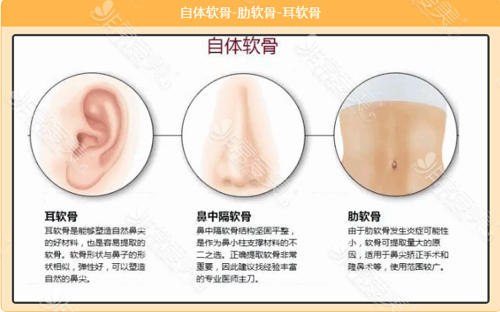 自體軟骨隆鼻 自體軟骨隆鼻