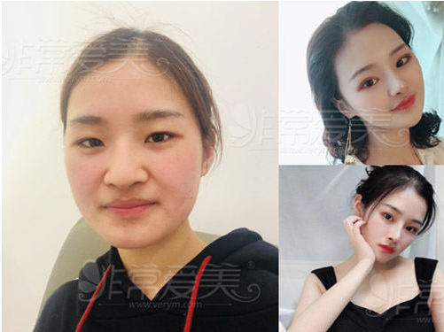 韓國純真整形外科隆鼻案例 韓國純真整形外科隆鼻案例
