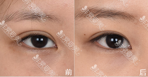 爱丽克医院眼修复前后图 爱丽克医院眼修复前后图