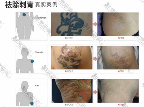 韩国科琳挞图洗纹身可以不留疤图片 韩国科琳挞图洗纹身可以不留疤图片