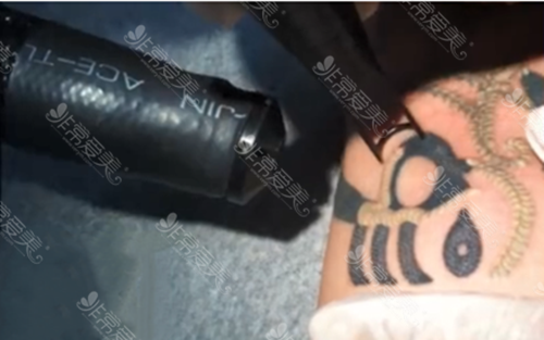 洗纹身超皮秒有什么优势 洗纹身超皮秒有什么优势