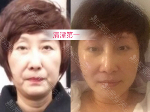 清潭First醫院面部提升案例 清潭First醫院面部提升案例