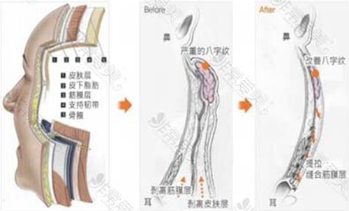 縱深肌理歸位術前后示意圖 縱深肌理歸位術前后示意圖