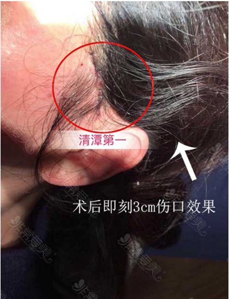 清潭First醫院面部提升傷口 清潭First醫院面部提升傷口