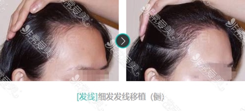 女性發際線調整手術對比案例