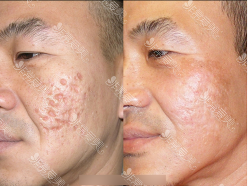 林二石醫院去痘印案例 林二石醫院去痘印案例