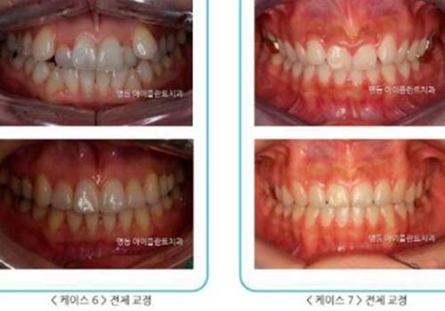 韩国iplant牙科医院牙齿矫正日记图