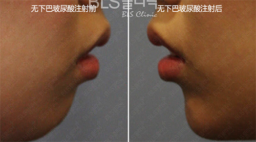 韓國BLS整形外科玻尿酸豐下巴手術案例 韓國BLS整形外科玻尿酸豐下巴手術案例