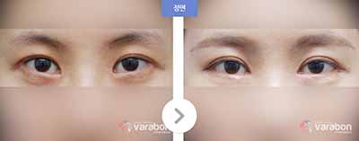 韩国芭啦本整形外科眼部修复案例图