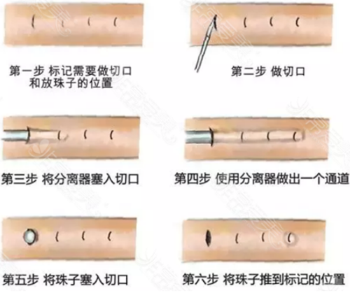 入珠手术示意图 入珠手术示意图