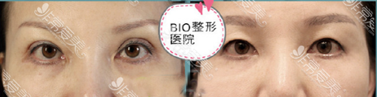 辛容镐双眼皮变单眼皮案例 辛容镐双眼皮变单眼皮案例