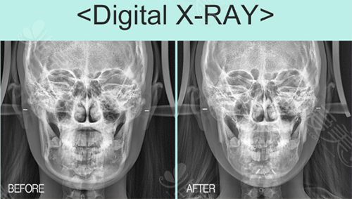 下颌角手术x-ray手术对比图 下颌角手术x-ray手术对比图