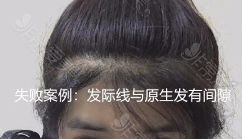 发际线种植失败案例 发际线种植失败案例