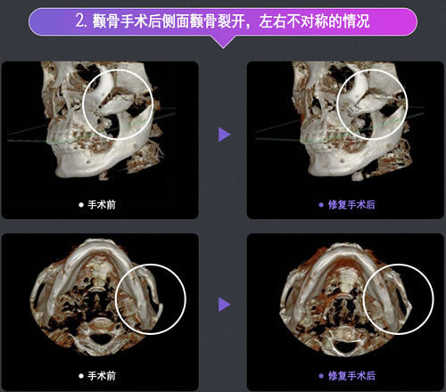 韩国DA颧骨开裂修复手术示意图