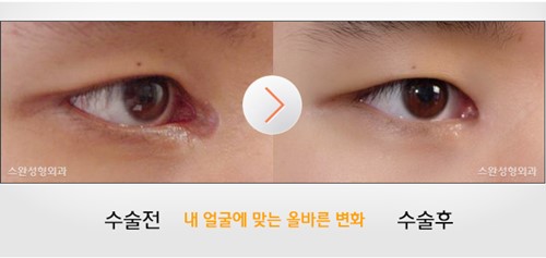 韩国Swan天鹅整形修复失败眼角案例
