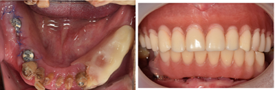 牙齿种植案例