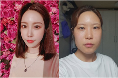 韩国TL整形外科面部轮廓手术案例