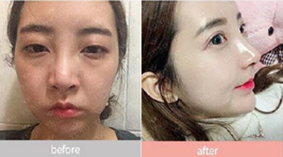 韩国朱诺鼻医院隆鼻前后3个月恢复照片
