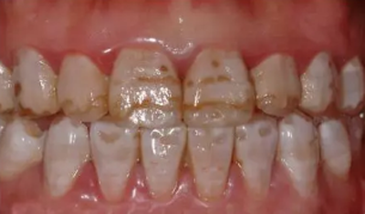 缺损型（重度）氟斑牙.png